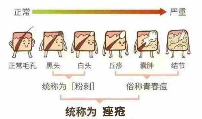 粉刺是什么样的（粉刺、痘痘、痤疮怎么区分）