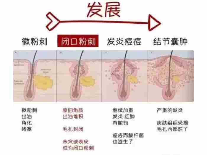 粉刺是什么样的（粉刺、痘痘、痤疮怎么区分）