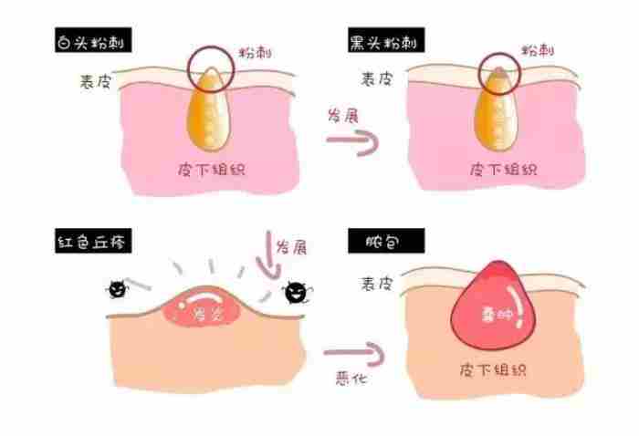 粉刺是什么样的（粉刺、痘痘、痤疮怎么区分）