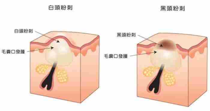 吸黑头粉刺仪器有用吗（电动吸黑头仪到底值不值得买）