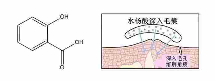 水杨酸可以祛痘吗（被誉为战痘神器的水杨酸火了）