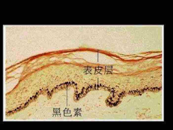 黑色素沉淀怎么去除 黑色素形成的过程是什么