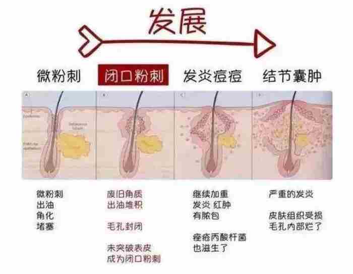 如何区分脂肪粒与粉刺?看这4点就够了